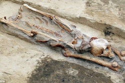 Remains of an accused vampire from the Middle Ages with the skull placed between the legs.